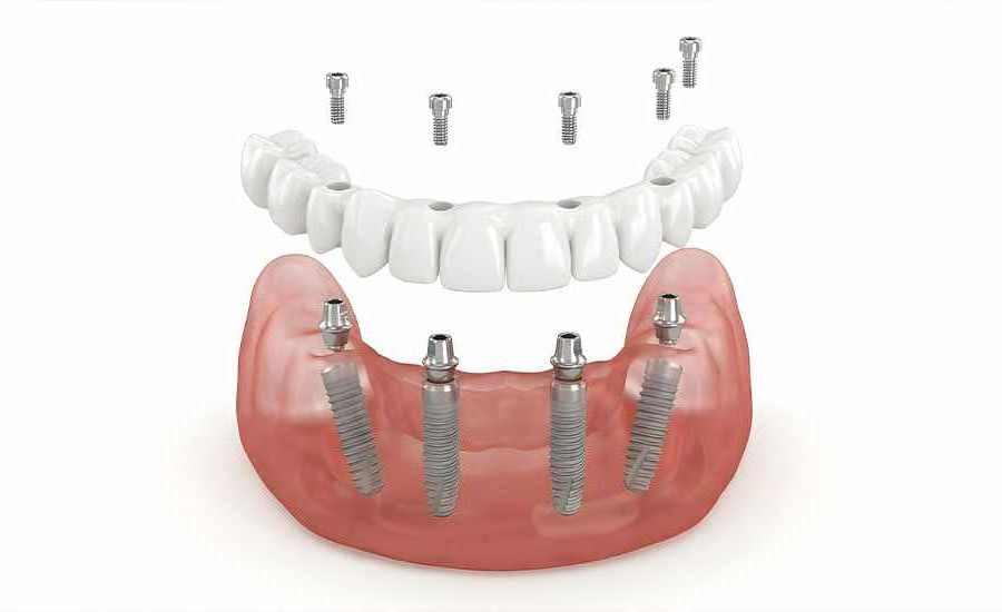 Illustration einer festsitzenden Brücke auf Implantaten im Kiefer