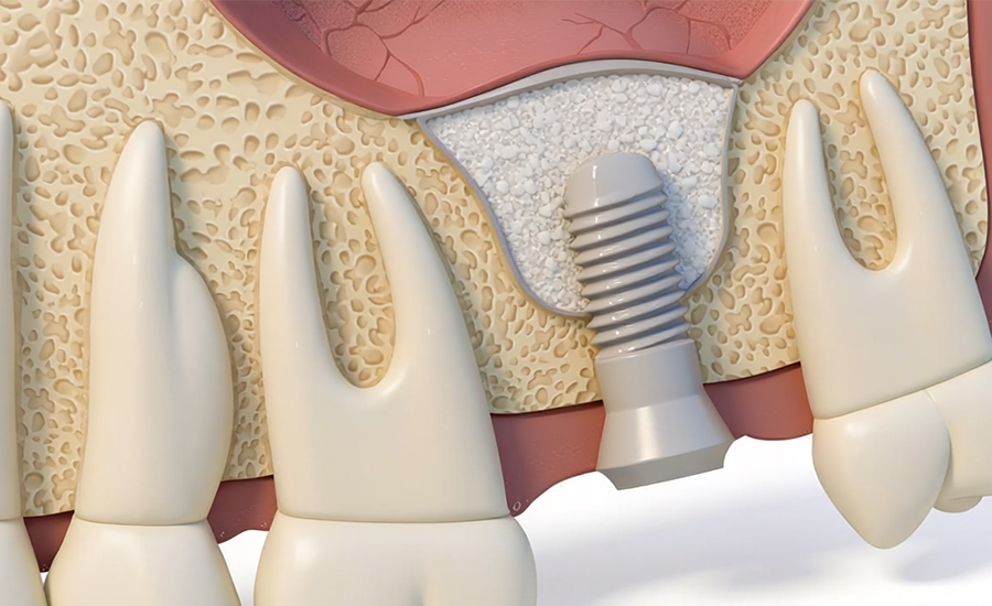 Sinuslift Knochenaufbau – Implantat mit Knochenaufbaumaterial im Querschnitt, Dr. Daniel Kalla Wien