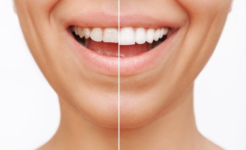 Full Mouth Rehabilitation